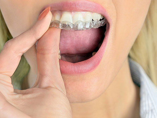 removing retainer or clear braces