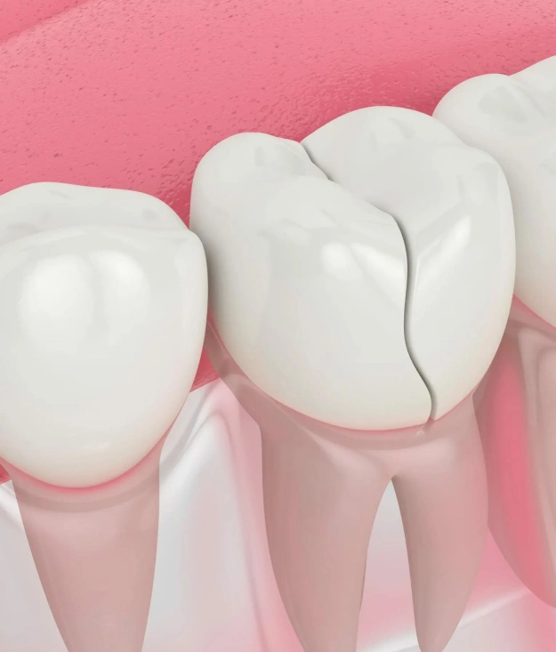Cracked tooth next to healthy tooth on pink background illustrating dental damage and repair.
