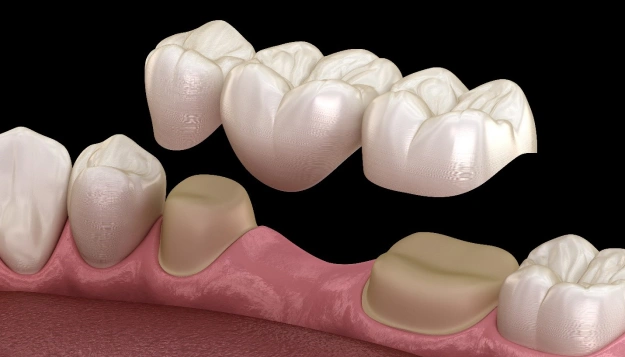 Dental crown restoration showing before and after placement on tooth model with gum tissue.
