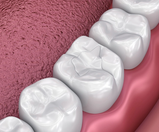Three white dental crowns displayed on pink gum model showing dental restoration procedure.