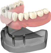 Dental implant model showing artificial teeth attachment to jawbone structure for patient education.