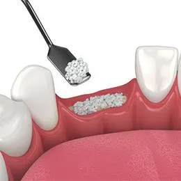 Dental implant procedure illustration showing bone graft material being placed in tooth socket preparation.