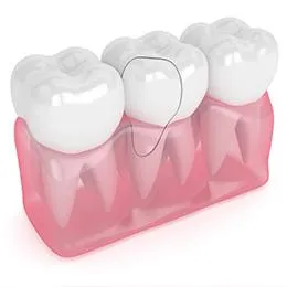 Three white dental crowns on pink gum model showing restorative dentistry procedure.