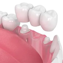 Dental bridge prosthetic placement illustration showing ceramic crowns on implants in pink gum model.