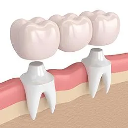 Dental implants illustration showing tooth structure, implant posts, and crown replacements in gum tissue.