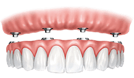 Dental implant bridge model showing pink gum structure above artificial tooth crowns.