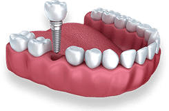 Dental implant model showing tooth replacement procedure on gum structure with crown and fixture.
